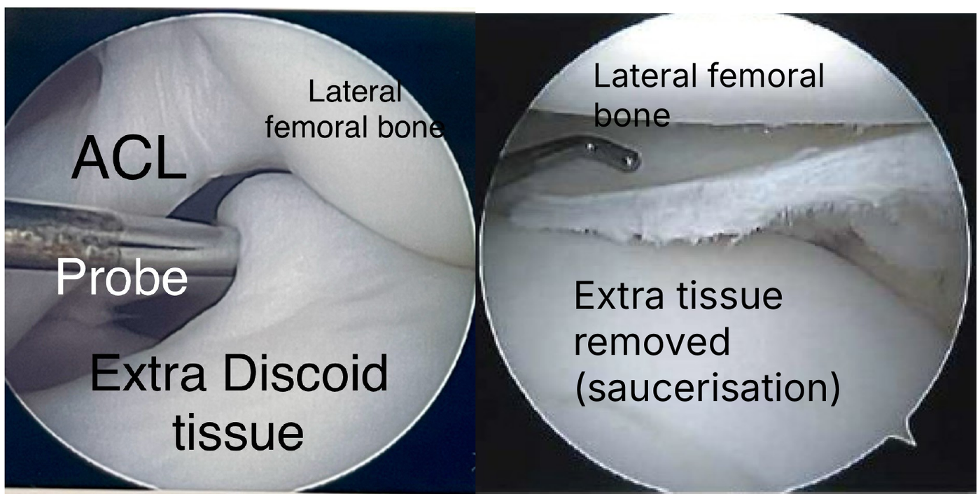 Keyhole camera views inside the knee. Left: before surgery, a probe touches the extra discoid tissue below the thigh bone. Right: after saucerisation, the extra tissue has been removed, leaving a normal-shaped rim.