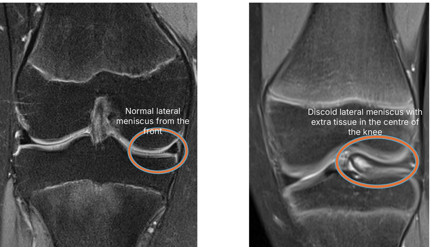 MRI scans of the knee viewed from the front. Left: a normal outer meniscus, a thin wedge at the edge of the joint. Right: a discoid meniscus with extra tissue reaching into the centre of the knee.