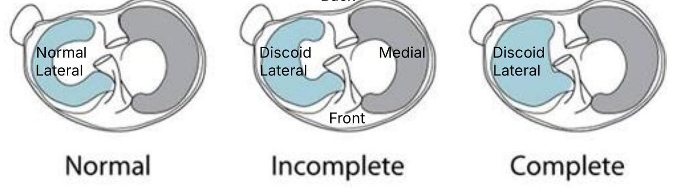 A right knee viewed from above, with the front of the knee at the bottom. Left: a normal C-shaped outer meniscus. Middle: an incomplete discoid meniscus that covers more of the bone. Right: a complete discoid meniscus that covers the whole outer side.